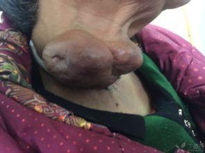 腺象体手术后可以吃瓜吗,瓜类食物的适宜摄入时间